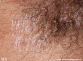 lichen sclerosus et atrophicus