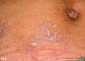 lichen sclerosus et atrophicus