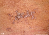 lichen sclerosus et atrophicus