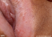 lichen sclerosus et atrophicus