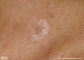 lichen sclerosus et atrophicus