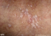 lichen sclerosus et atrophicus