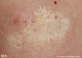 lichen sclerosus et atrophicus