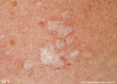 lichen sclerosus et atrophicus