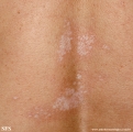 lichen sclerosus et atrophicus
