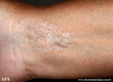 lichen sclerosus et atrophicus