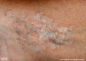 lichen sclerosus et atrophicus