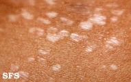 lichen sclerosus et atrophicus