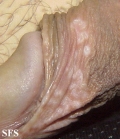 lichen sclerosus et atrophicus