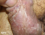 lichen sclerosus et atrophicus