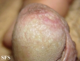 lichen sclerosus et atrophicus
