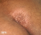 lichen sclerosus et atrophicus