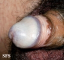 lichen sclerosus et atrophicus