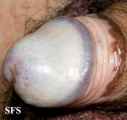 lichen sclerosus et atrophicus