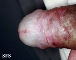 lichen sclerosus et atrophicus