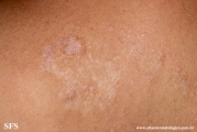 lichen sclerosus et atrophicus