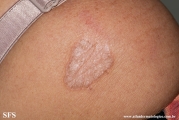 lichen sclerosus et atrophicus