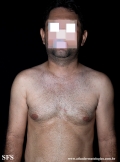 acquired hypomelanosis-hypopigmentation after sympathectomy