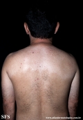 acquired hypomelanosis-hypopigmentation after sympathectomy