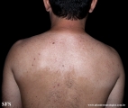 acquired hypomelanosis-hypopigmentation after sympathectomy