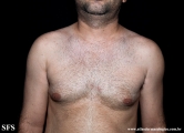acquired hypomelanosis-hypopigmentation after sympathectomy