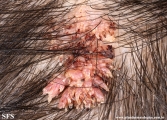 warts filiformis