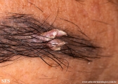 warts filiformis