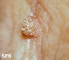 warts filiformis