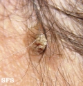 warts filiformis