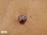 warts filiformis