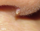 warts filiformis