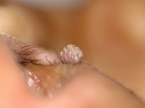 warts filiformis