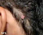 warts filiformis