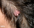 warts filiformis