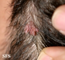 warts filiformis