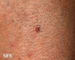 warts filiformis