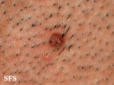 warts filiformis