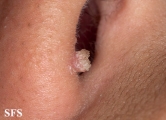 warts filiformis