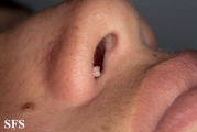 warts filiformis