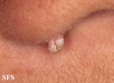 warts filiformis