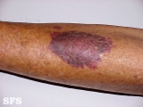 purpura senilis