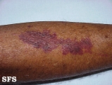 purpura senilis