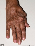 rheumatoid_arthritis