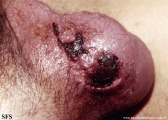 fournier's gangrene