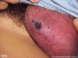 fournier's gangrene