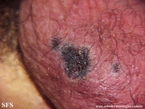 fournier's gangrene