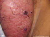 fournier's gangrene