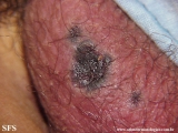 fournier's gangrene