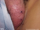 fournier's gangrene