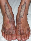 inflammatory linear verrucous epidermal naevi-bilateral